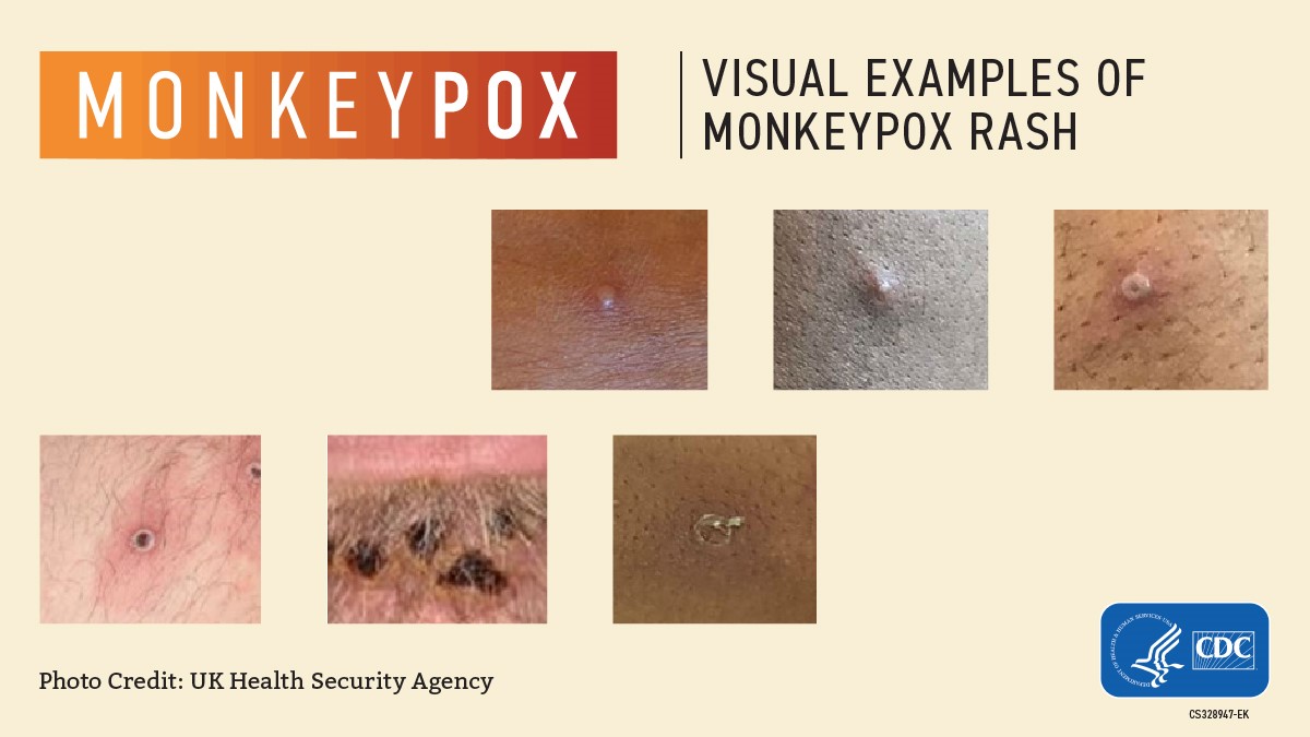 Monkeypox-Health-Resources-NY-Monkeypox-Data-Fidelis-Care