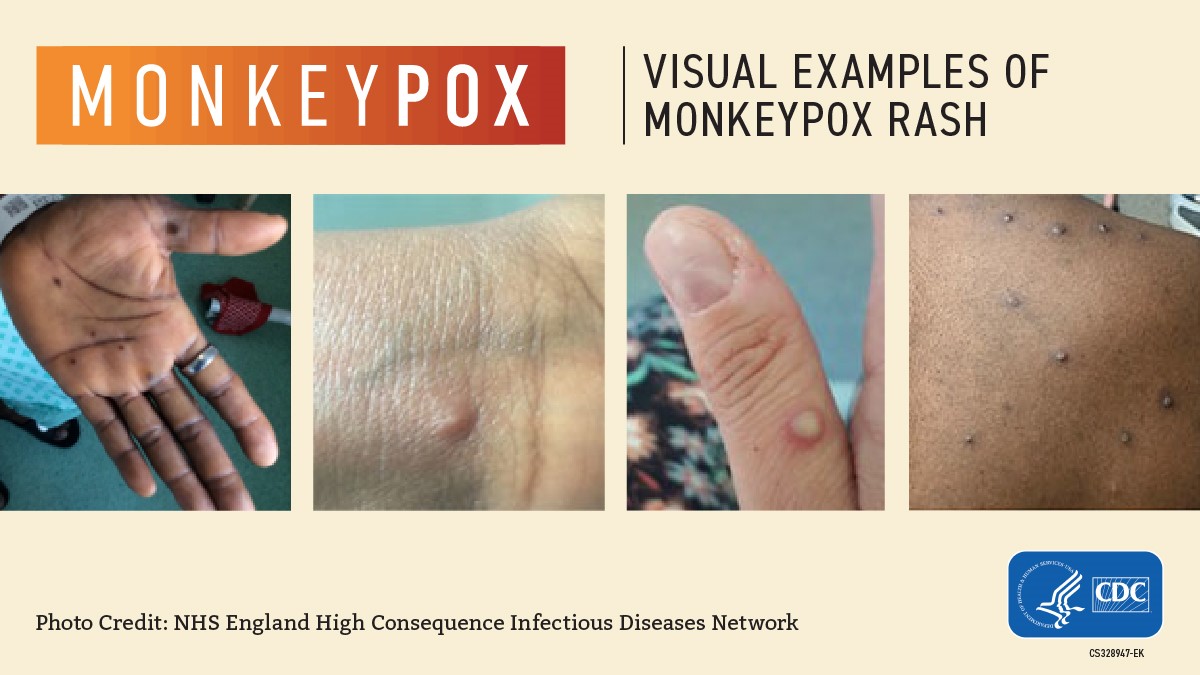 Monkeypox-Health-Resources-NY-Monkeypox-Data-Fidelis-Care